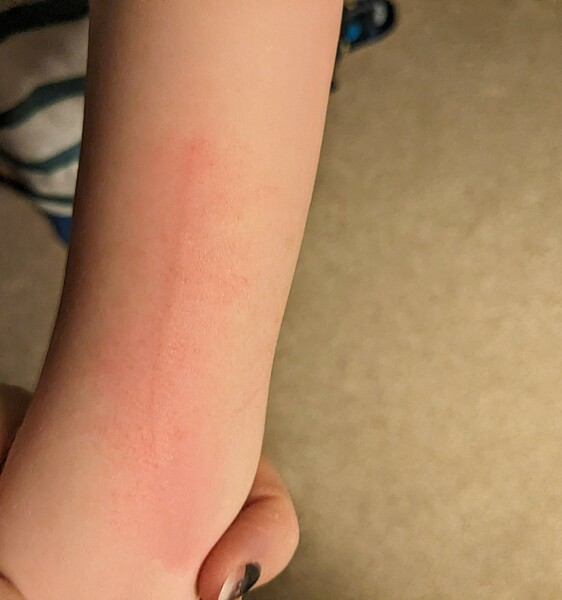 Burnt arm 3 year old