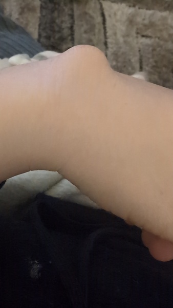 Finger lump