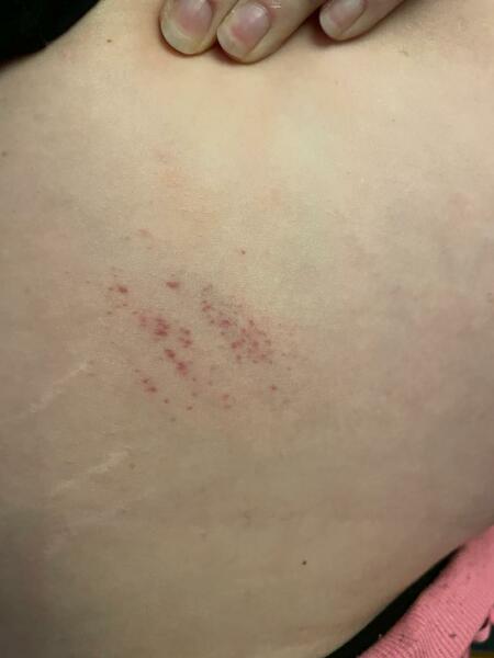 24 weeks- little rash on side of belly?