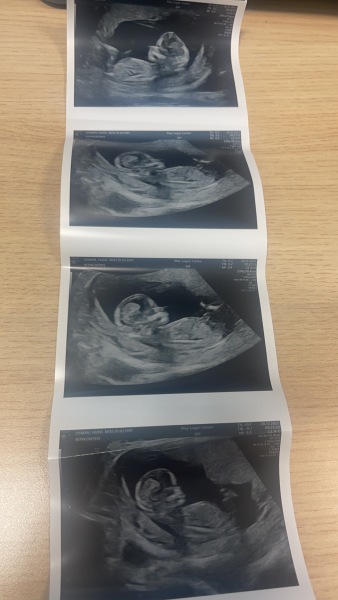 Pregnancy gender