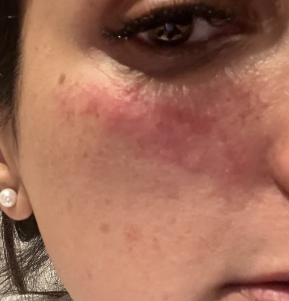 Hives on face - what do I do? Going on holiday
