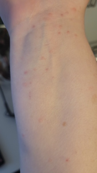 Rash Advice