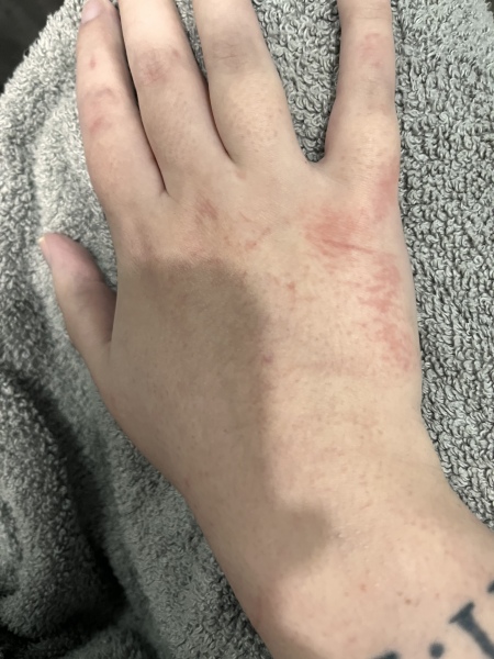 Hand rash