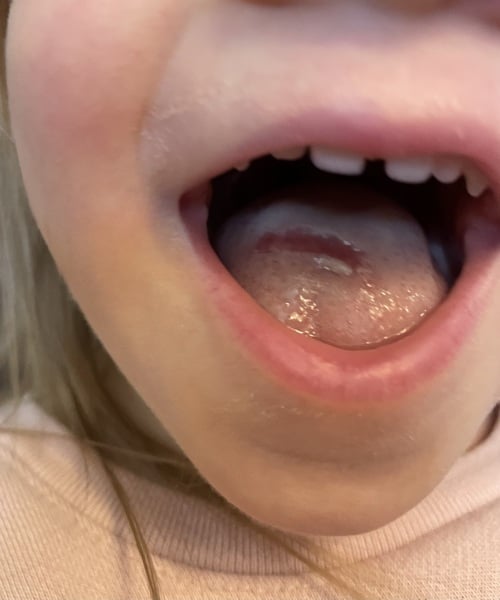 Spot on tongue