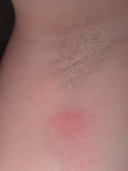 Abcess/cyst whatever it is. Please help me sporners.