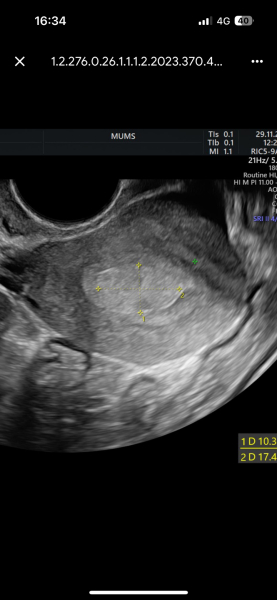 Endometrial polyp seen... scared SCAN RESULTS ATTACHED