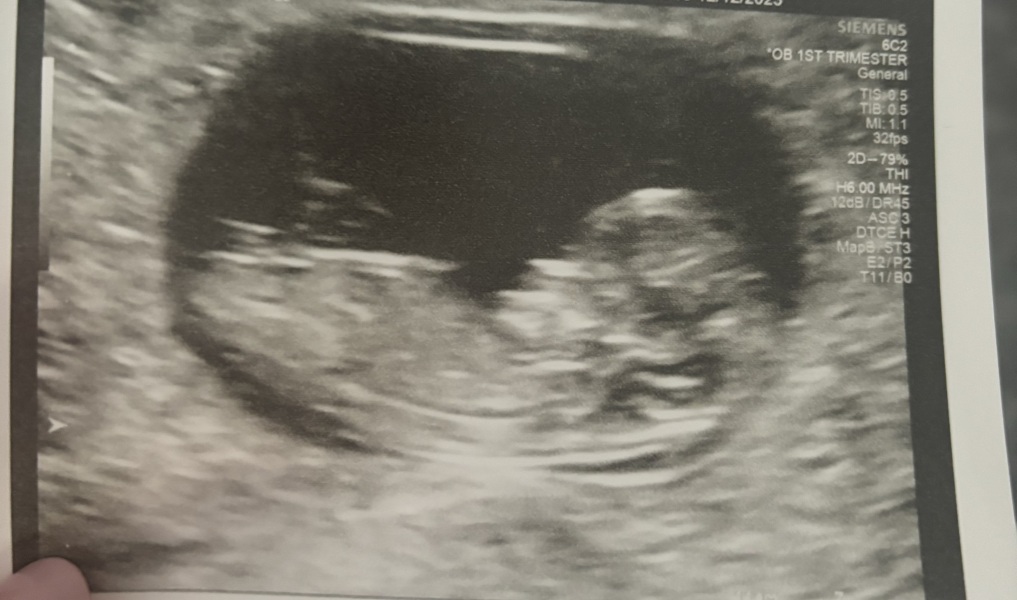 Can anyone see a nub on these scans?