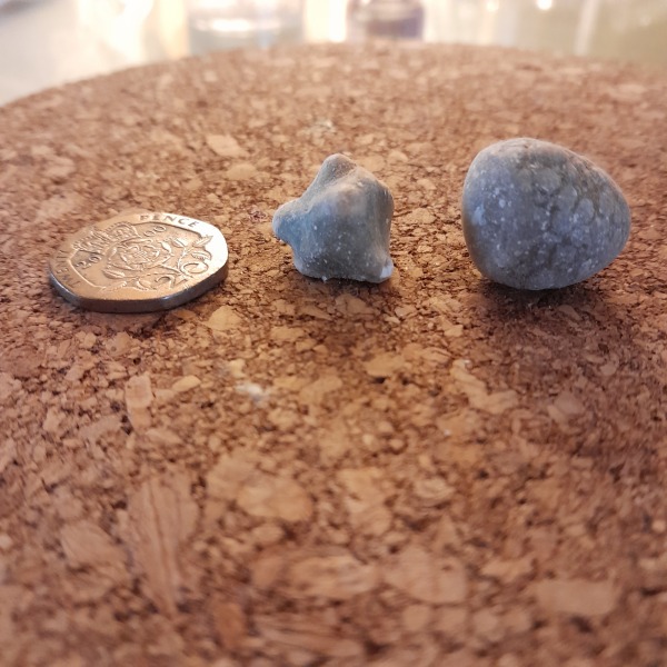 Just found my gallstones, photo.