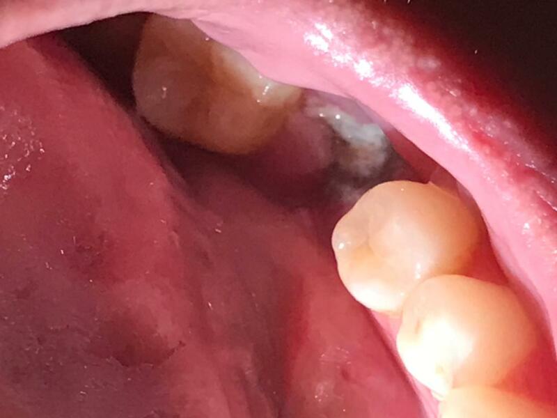 Tooth extraction - is this normal? Photo TMI!