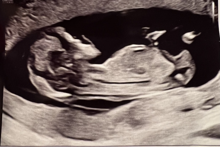 12 week scan Gender Predictions
