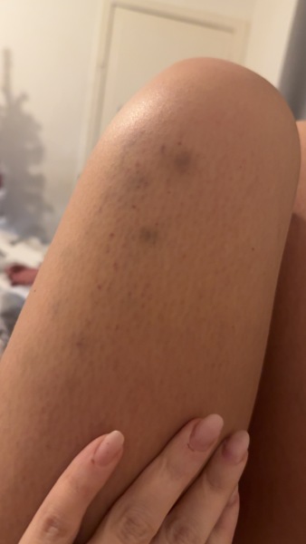 Strange bruising and purple spots