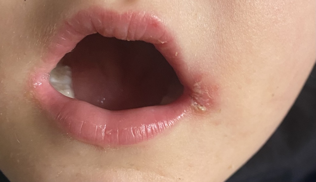 What is this on child’s mouth?