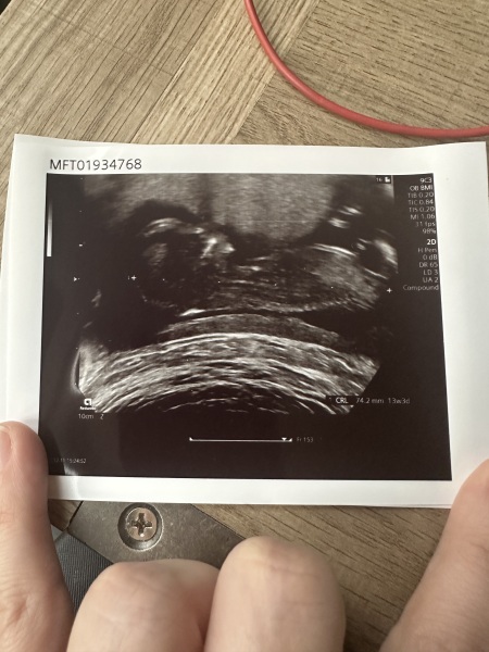 Gender guess 13 weeks