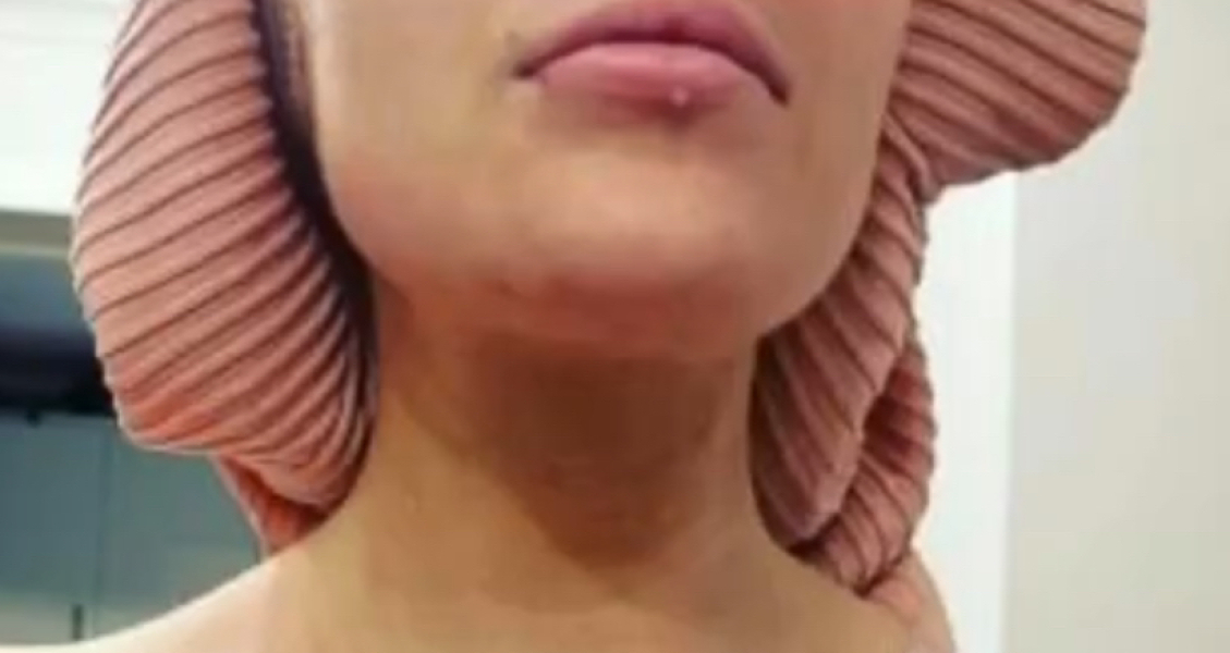 Lemon Bottle - fat dissolving injections.