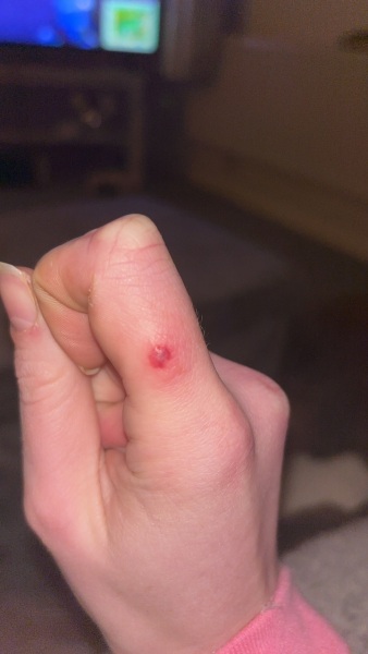 Does this blister look infected?