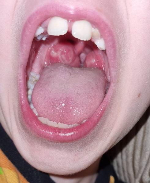 Is this tonsillitis?