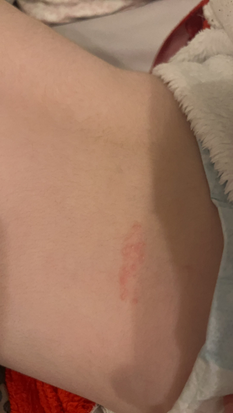 What is this rash?