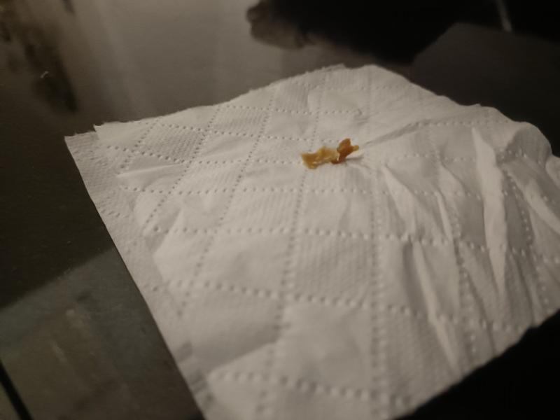 Fabulous earwax *tmi pic*