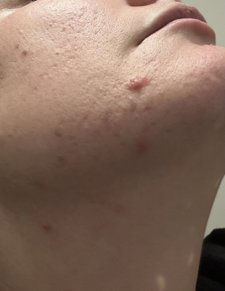 Acne spots in your 30's