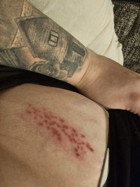 What is this rash?
