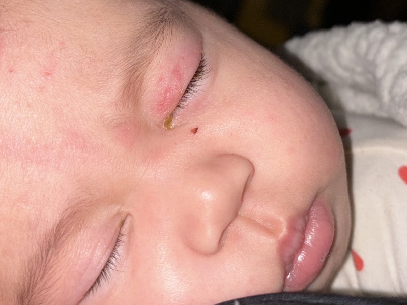 Blocked tear duct or conjunctivitis?