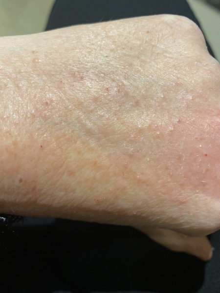 To ask does this look like scabies?!