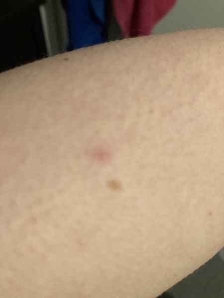 What is biting me?