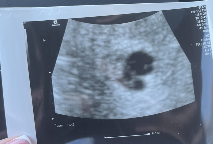 Is it bleeding? Multiple pregnancies? Please help!