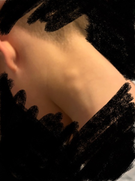 Should I be worried about lumps on neck? Photo