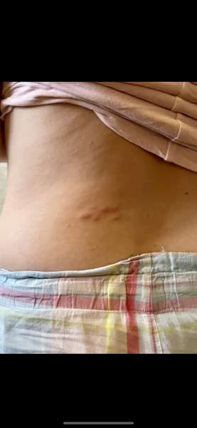 To ask what this rash could be..??
