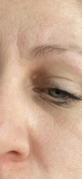 Weird lump on eyelid