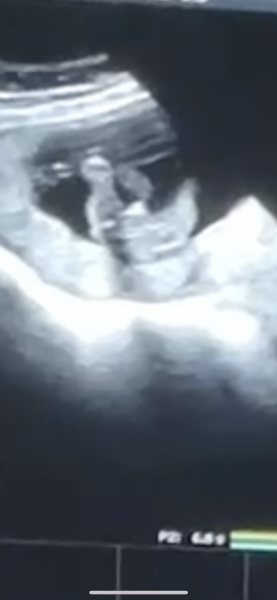 Private gender scan at 16 weeks