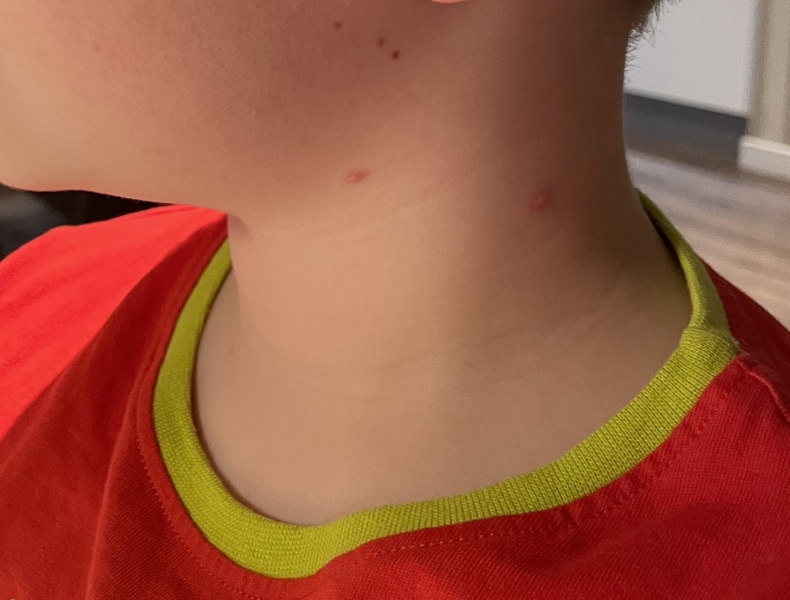 Chicken Pox?!