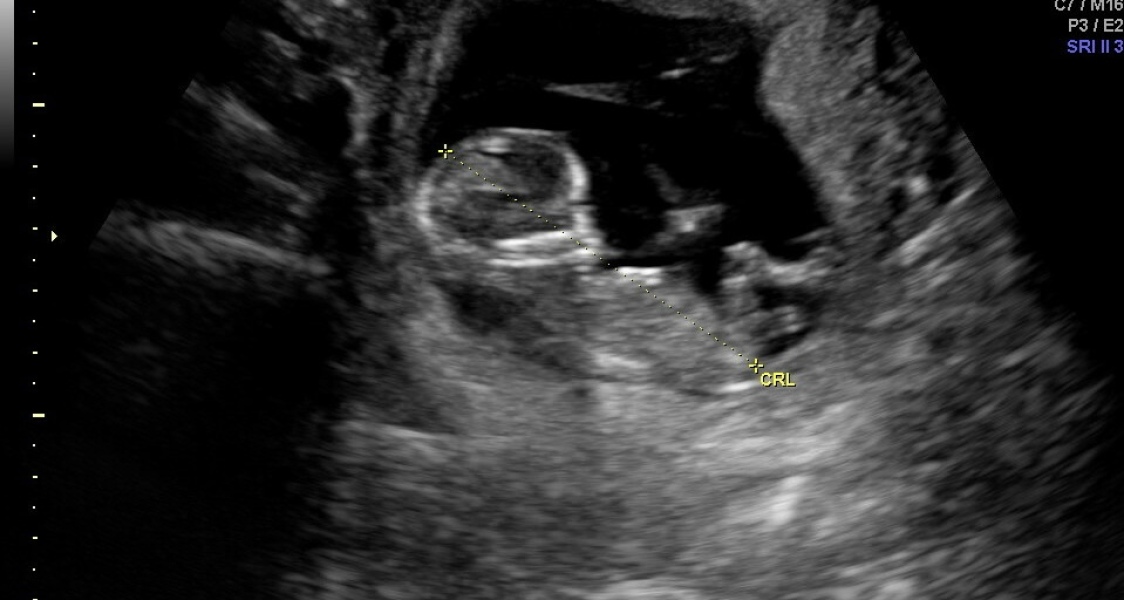 Nub theory - Can anyone guess the gender?