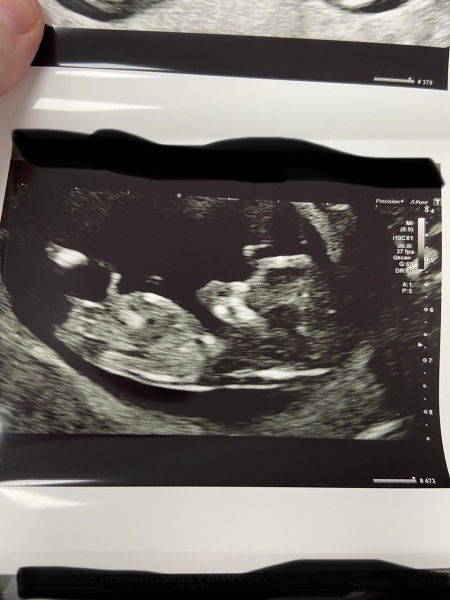 Boy or girl? 12 weeks scan