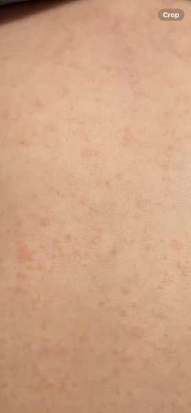 Chest infection then roseola?