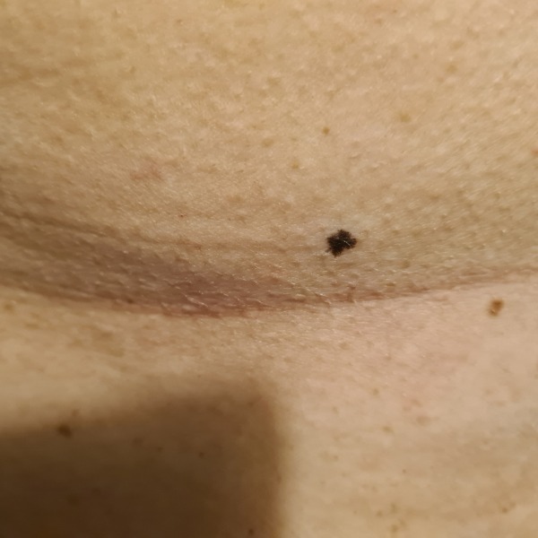 Mole / freckle issue?