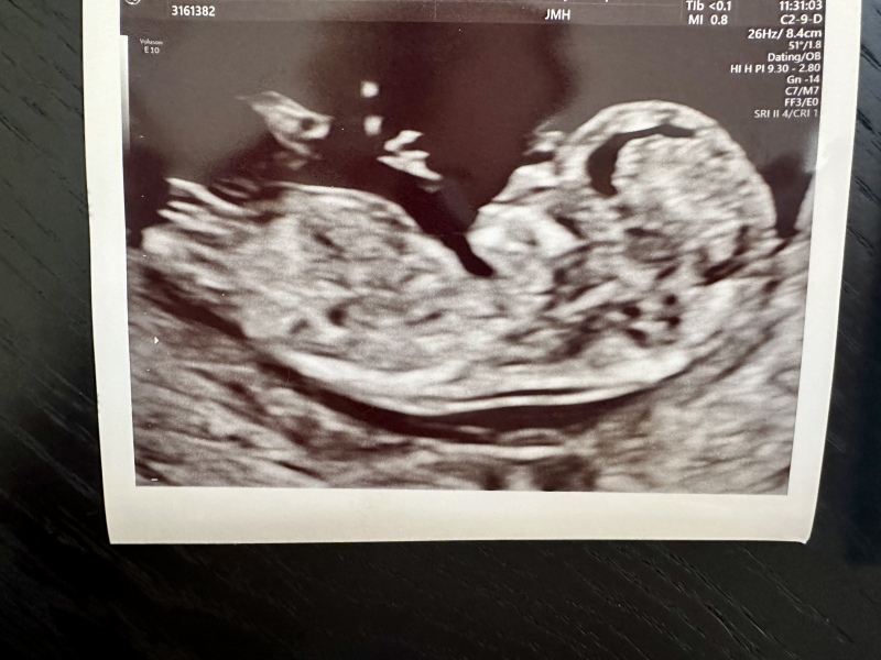 Nub theory guesses - girl or boy?