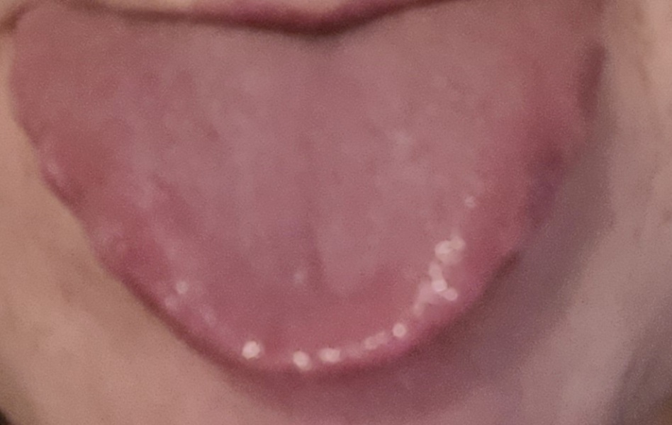 Lumps on tongue/allergic reaction