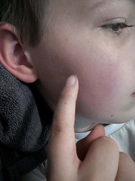 Cheekbone pain?