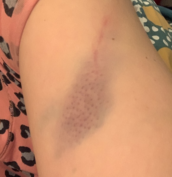 Dotty Bruise