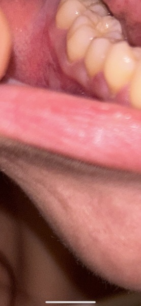Gum issues