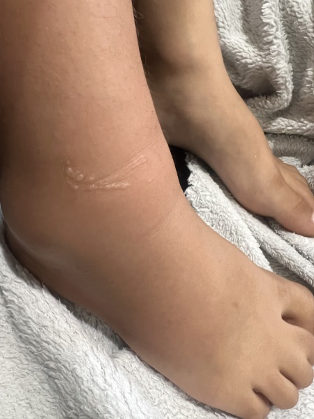 Insect bite?