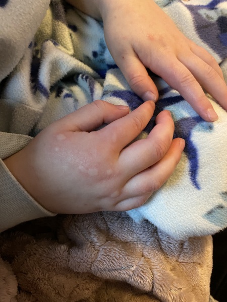 Hand foot and mouth