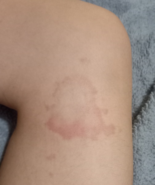 Rash help