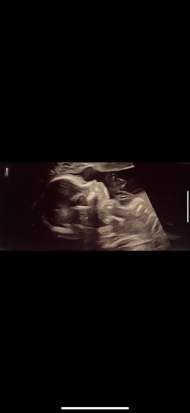 Do you think these ultrasounds are the same sex?