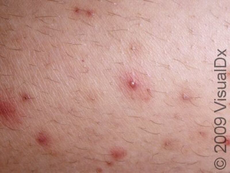To ask for help with what is biting me?