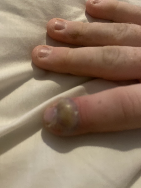 Infection skin looks worse?