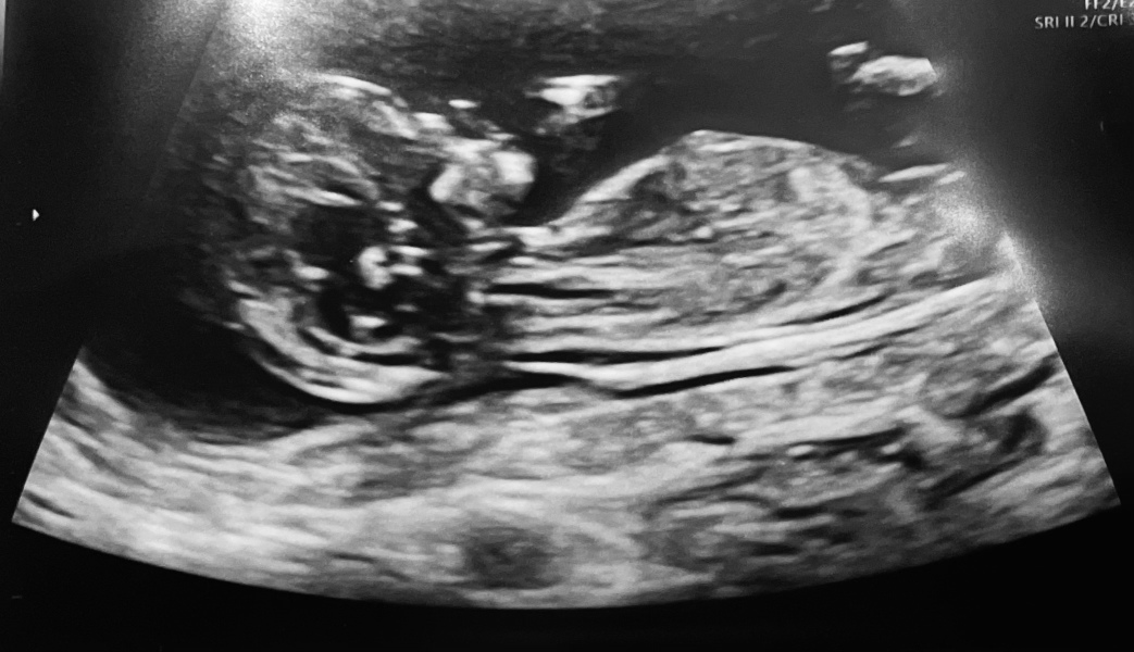 Any 12 week scan guesses?!😍