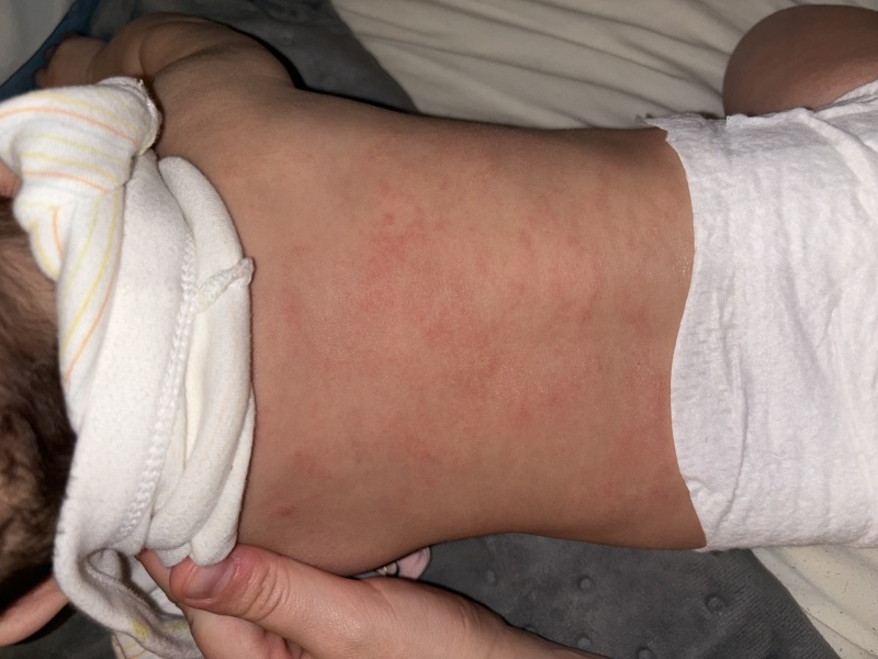 Baby rash?